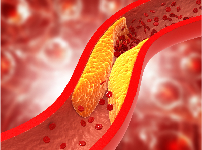 The International Treatment Guidelines for Dyslipidemia